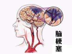 養(yǎng)成好的生活習(xí)慣，能夠有效預(yù)防腦梗塞